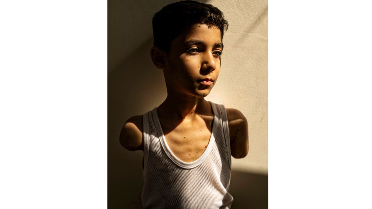 वर्षकै उत्कृष्ट बन्यो दुवै हात गुमाएका प्यालेस्टिनी बालकको तस्वीर